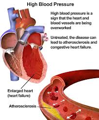 Cure Treat Hypertension easily BP high lower blood pressure
