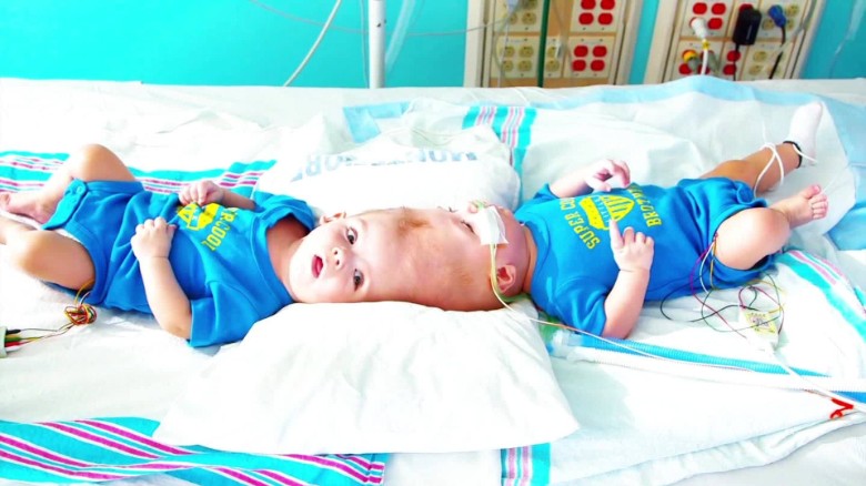 Twins conjoined at head successfully separated after 27 